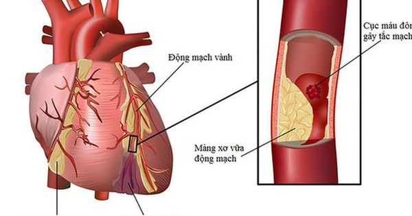 5 bien phap giam nguy co bien co tim mach khi thoi tiet lanh 6936af9651f51