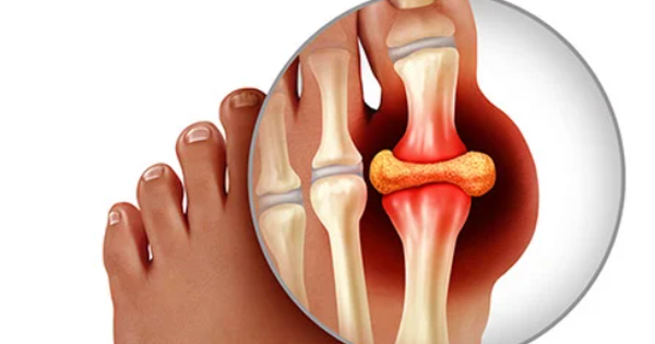 bi gout tai di tai lai chua the nao 6964c201a9a37